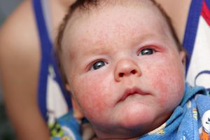 Лечение аллергии у новорожденных