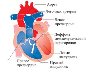 Патологии в работе сердца