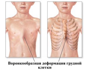Деформации грудной клетки у детей