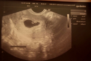 Эмбрион в 4 недель беременности