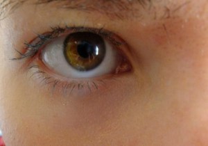Как лечить желтизну глаз