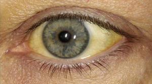 Как лечить желтые глаза