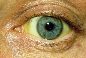 Причины желтых глаз