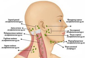 Воспаление лимфоузлов на шее