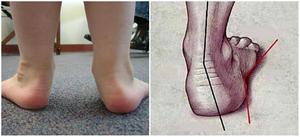 Причины  вальгусной деформации стопы у ребенка