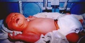 Отёчная форма гемолитической желтухи у новорожденных