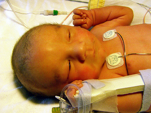 Как лечить желтуху у новорожденных