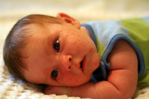Акне на лице у новорожденного комаровский thumbnail