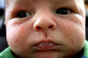 Прыщи на лице у новорожденного комаровский