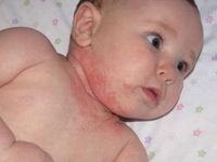 Аллергия у новорожденых