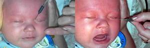 Симптомы дакриоцистита у новорожденных
