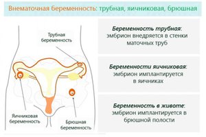 Способы определения внематочной беременности
