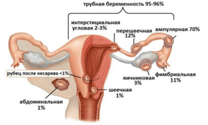 Симптомы наступления внематочной беременности