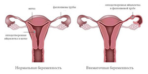Как может наступить внематочная беременность