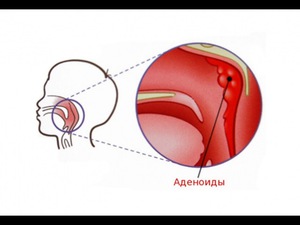 Метооды лечения аденоидов
