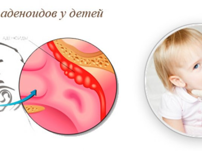Лечить аденоиды у ребенка форум. Аденоиды аденоидные вегетации 2 степени. Гипертрофия аденоиды 2 степени.