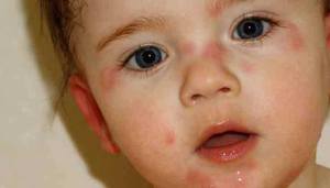 Высыпания на коже у ребенка при аллергии