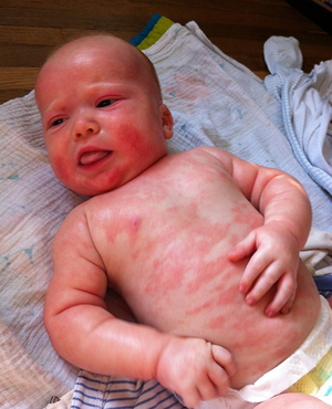 Ребенок с аллергией на молоко - симптомы