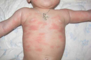 Аллергия на козье молоко - проявления и тесты