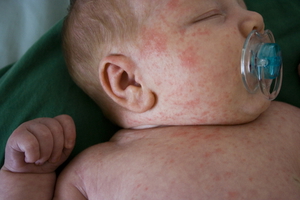 Как проявляется аллергия на коже малыша