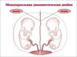 Как быть при беременности двойней