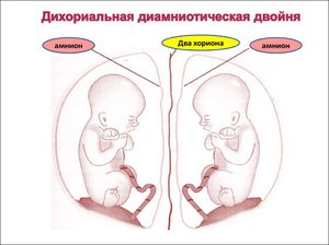 Как протекает беременность двойней