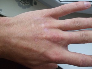Причины аллергии на руках