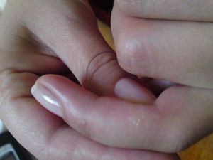 Симптомы аллергии на руках