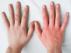 Как проявляется аллергия на руках