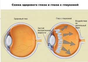 Заболевание Глаукома