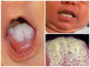 Плотный белый налет на языке предупреждает о развивающемся заболевании