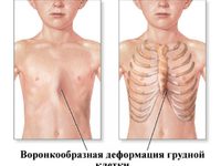 Деформации грудной клетки у детей