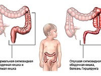 Болезнь гиршпрунга и ее последствия