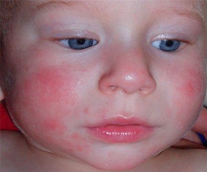 Как проявляется аллергия у детей
