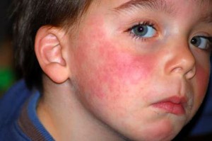 Аллергия на животных - варианты проявления