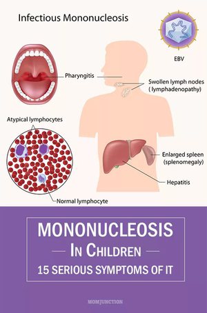 Мононуклеоз инфекционный у детей 