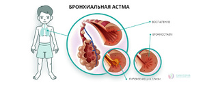 Какие симптомы у бронхиальной астмы