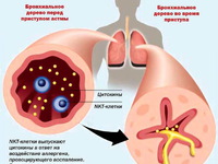 Как лечить астму