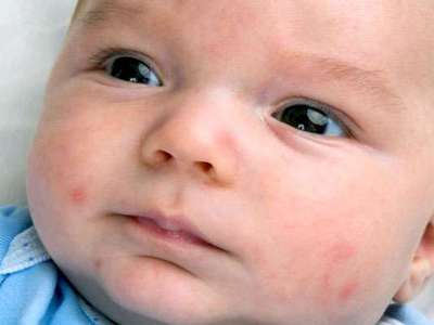 Основание появления красных пятен на лице у ребёнка: опасность мелких красных точек для грудничка