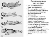 Признаки гипотрофии