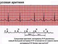 Синусовая аритмия