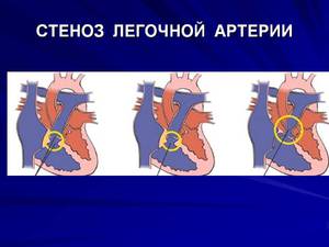 Стеноз легочной артерии у плода и новорожденного
