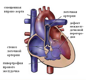 Аорта и легочная артерия 