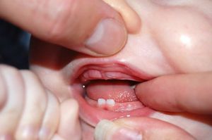 Красное горло при прорезывании зубов