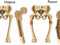 Признаки рахита у детей