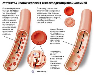 Железодефицитные анемии 