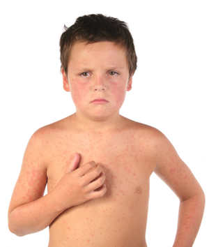 Краснуха -симптомы у детей