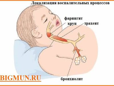 Трахеит — симптомы, диагностика и лечение в СМ-Клиника в Рязани