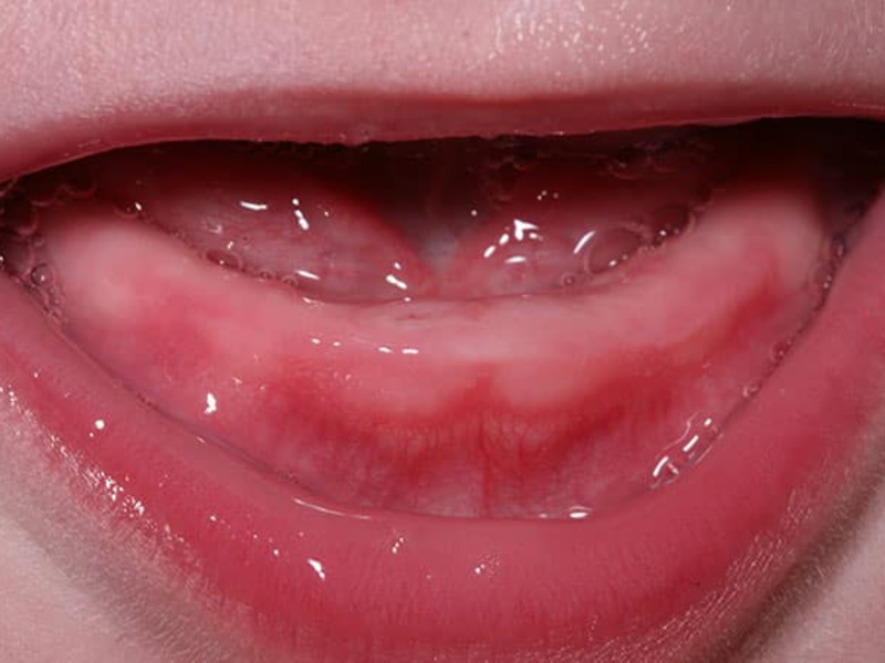 Как облегчить боль при прорезывании зубов