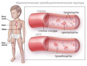 Тромбоциты у детей: норма